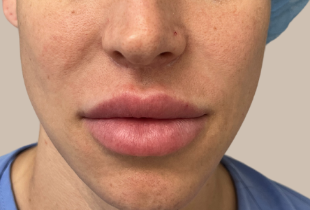 LIP-LIFT-NOT-INJECTIONS-after