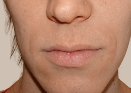 LIP-LIFT-NOT-INJECTIONS-before